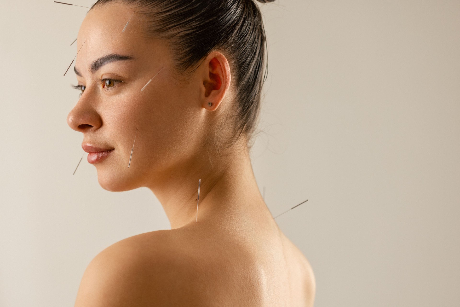 Acupuncture back and shoulder treatment, therapist and patient