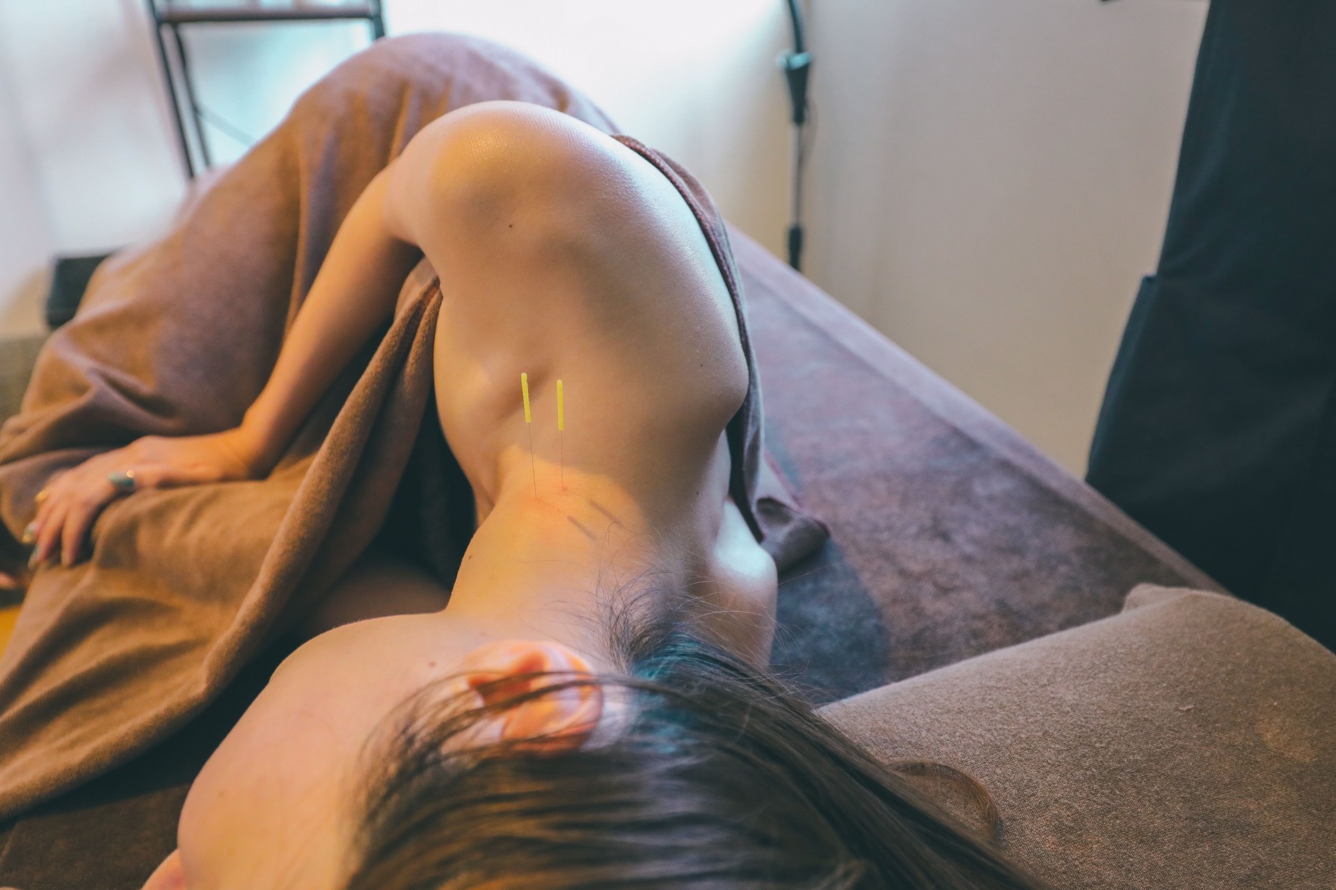 Neck acupuncture treatment