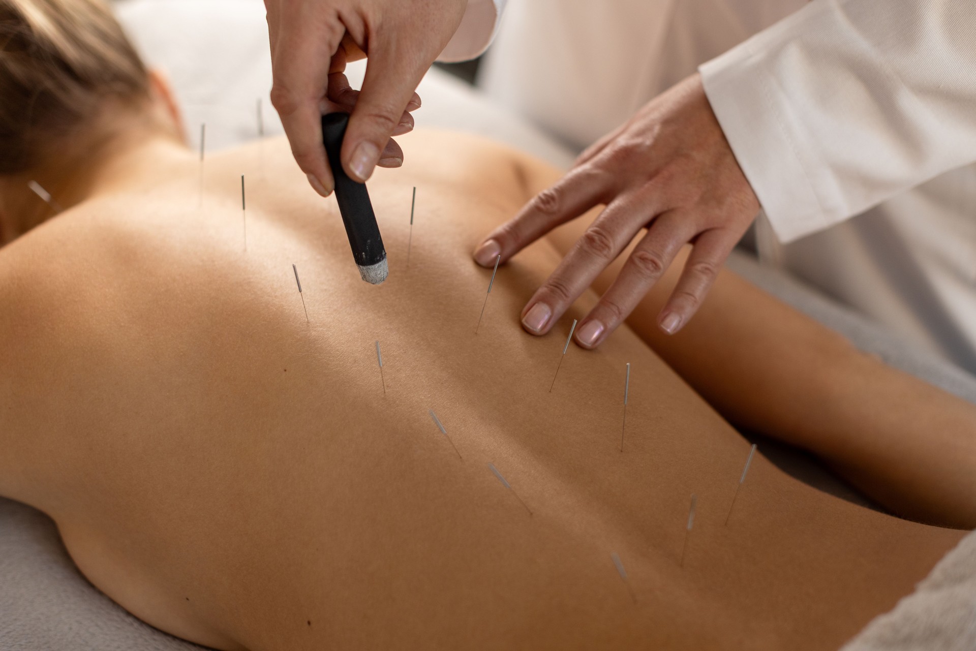 Woman lying down on a acupuncture bed, getting a treatment with acupuncture needles and moxa