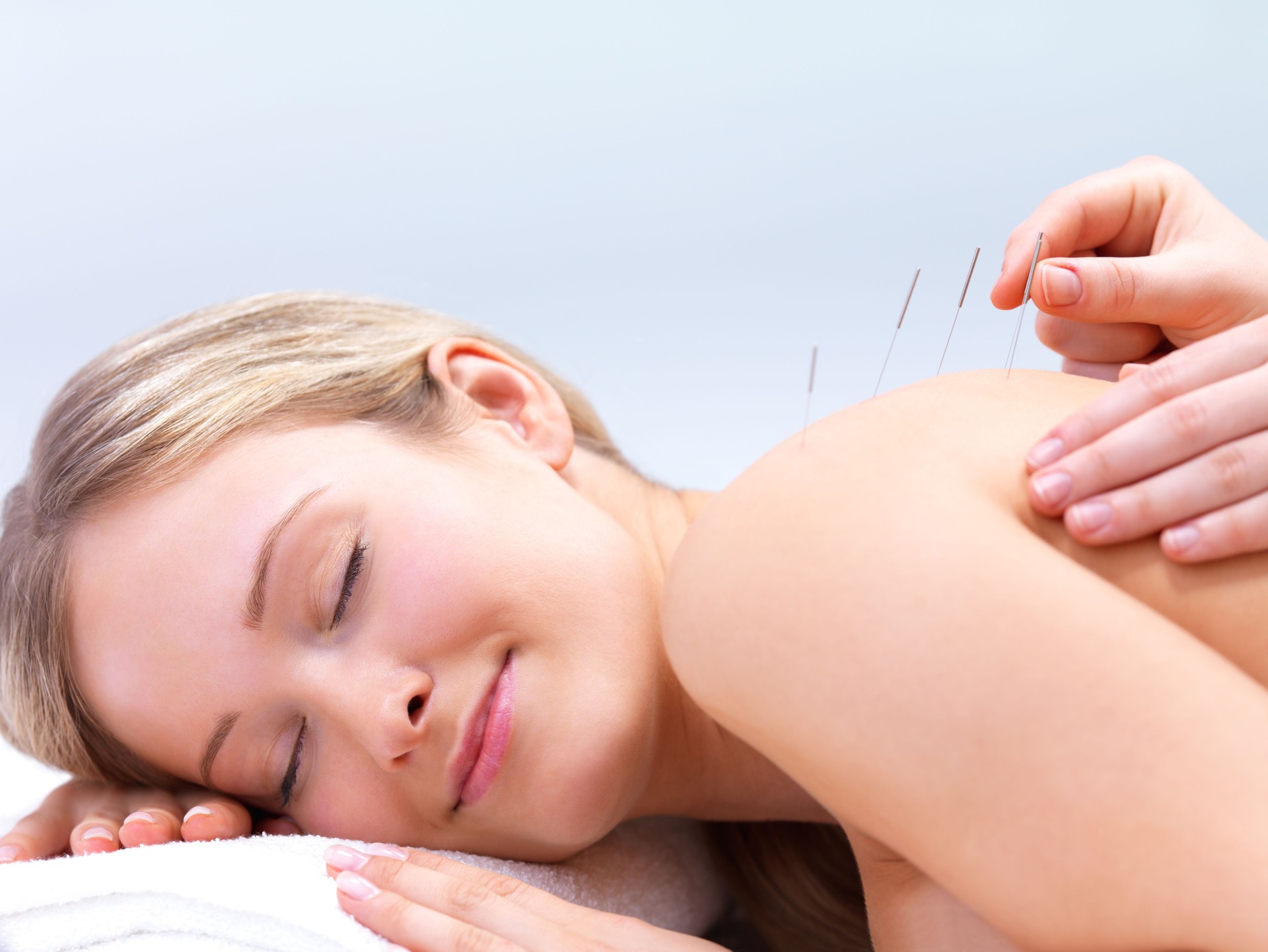 Acupuncture needles on the back of a beautiful young woman