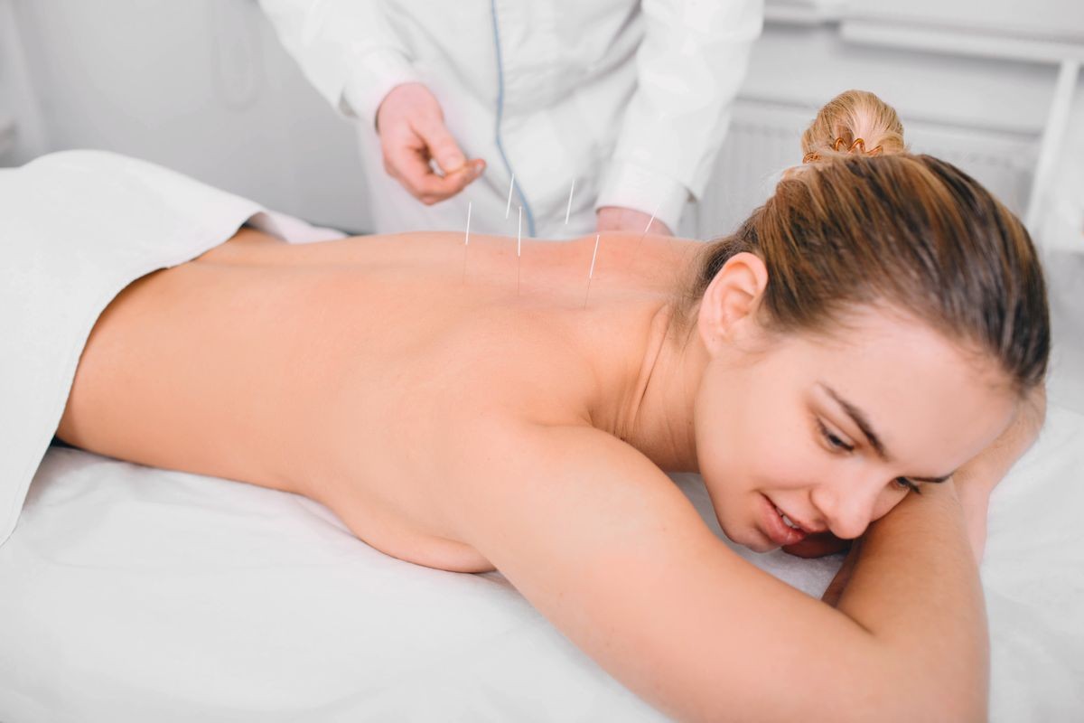 Caucasian woman having traditional chinese acupuncture treatment. Female back with acupuncture needle,